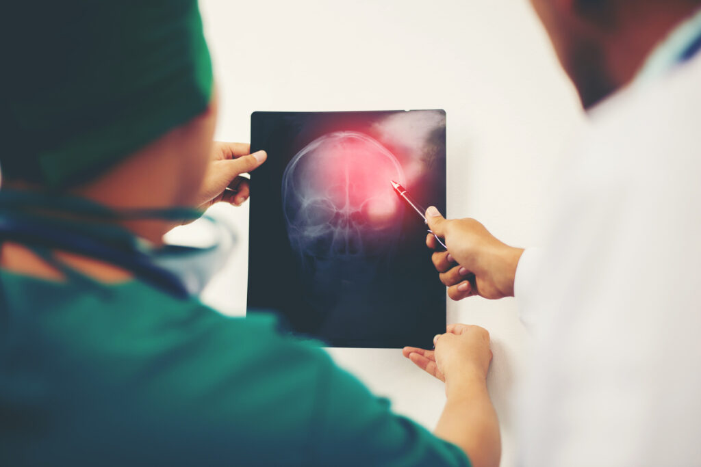 Glendora Brain Injury Attorneys